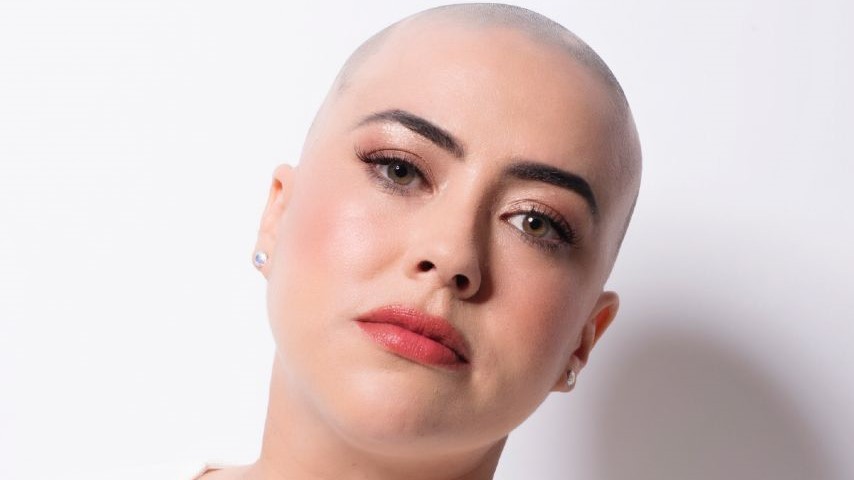 Kelly showing her bald head caused by her Alopecia Areata