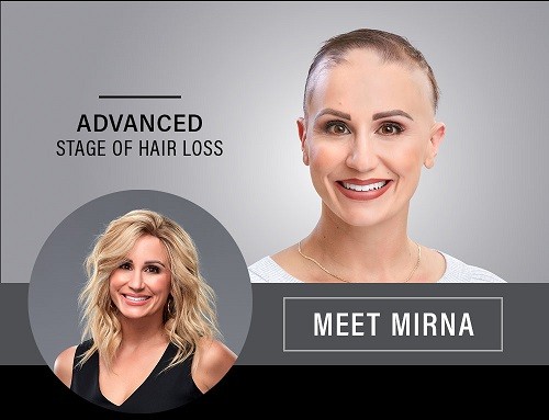 Mirna showing her hair loss and before and after she wears a wig