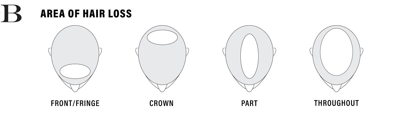 Infographic showing the various positions and ares of hair loss on your head.