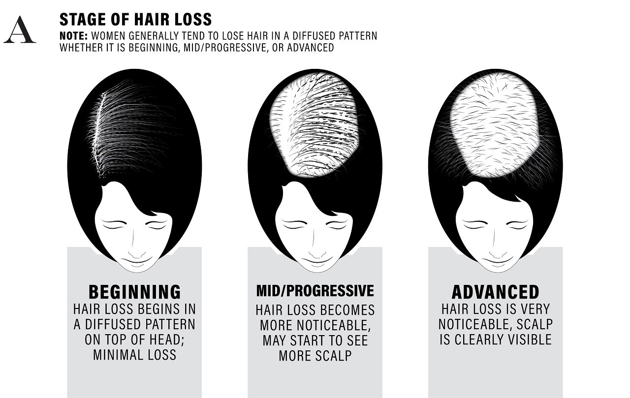 Infographic showing the various stages of hair loss in women.