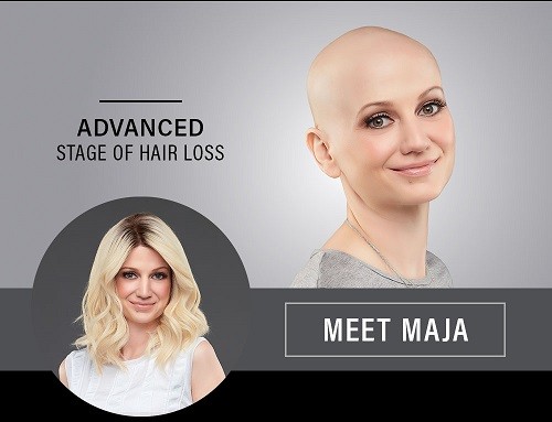 Lady showing her hair loss before and after she wears a wig