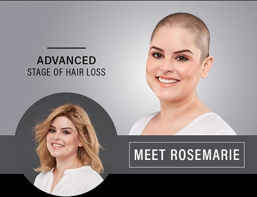 Lady showing her hair loss caused my alopecia